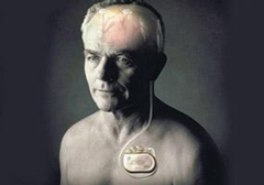 起搏器真的能治好帕金森病嗎？